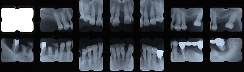 sy05X-ray+1