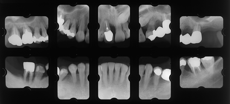 sy01X-ray+1